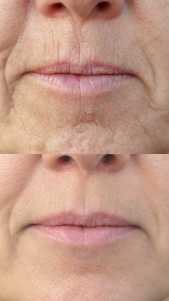 Before and after